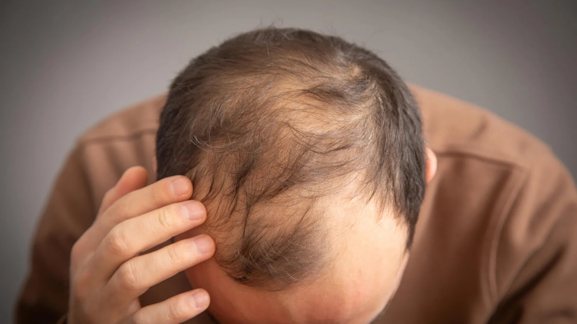 ارتباط احتمالی داروهای اوزمپیک و ویگووی با افزایش خطر ریزش مو در مردان